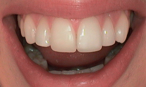 Chipped teeth restored with composite bonding