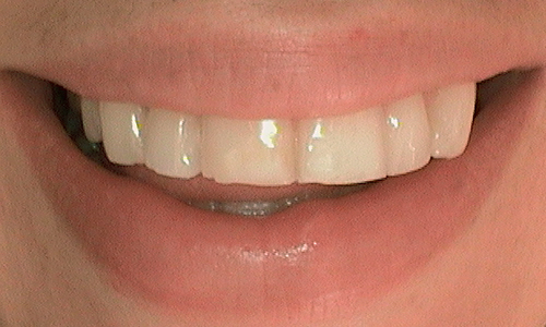 Chipped incisor edges before composite bonding