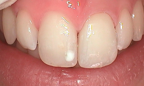 Upper teeth restored with aesthetic porcelain crowns