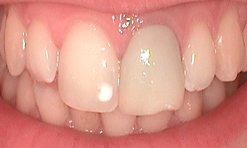Broken and heavily restored teeth before crowns