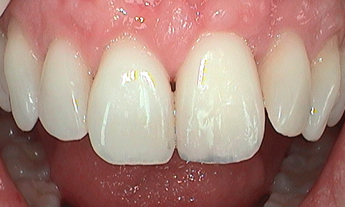 Dental implant with custom porcelain crown fitted