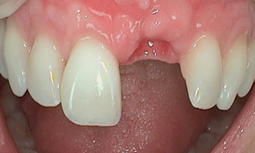 Missing central incisor before dental implant