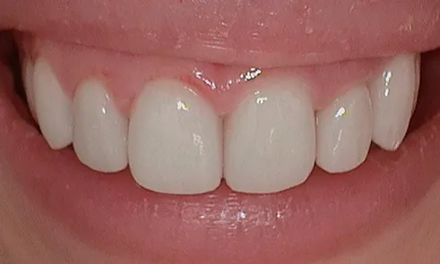 Porcelain veneers after aesthetic bonding