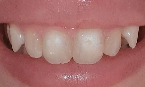 Porcelain veneers before treatment